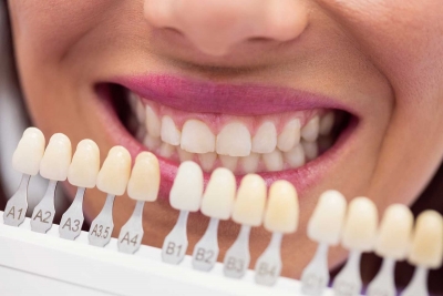 روکش سرامیکی و لمینت دندان  yousefdentistry